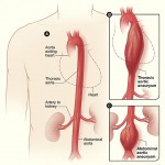 Aortic Aneurysm from National Heart, Lung and Blood Institute